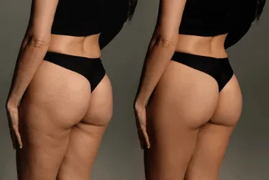 diete per la cellulite